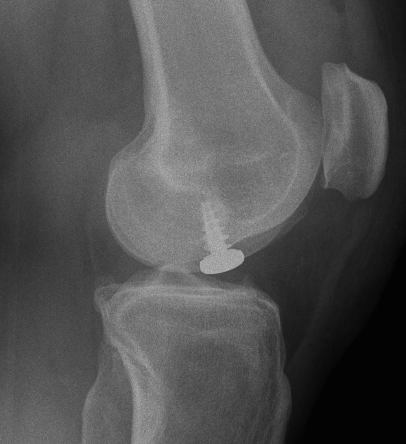 Knee Hemicap Lateral
